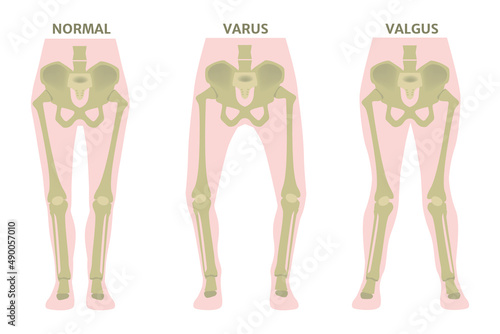 Valgus and varus leg deformities. Diagram showing the deformed bones of the lower extremities. Cosmetic pathology. Vector illustration.