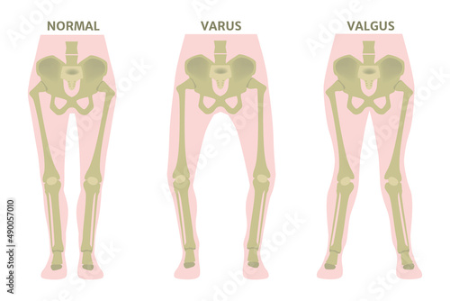 Valgus and varus leg deformities. Diagram showing the deformed bones of the lower extremities. Cosmetic pathology. Vector illustration.