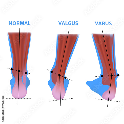Valgus deformity of the foot. Orthopedic pathology. Abnormal deformity of joints. Curvature of the feet. Vector illustration.