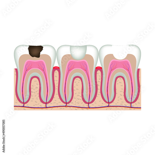 Caries. Stages of treatment of a tooth with a filling. Vector illustration photo