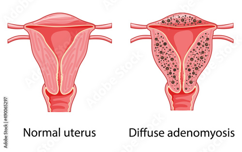 Diffuse Adenomyosis Human anatomy Female Sick vs normal reproductive system organs. Location Cross section scheme uterus vagina icon. Vector illustration disease disorder isolated medical reproduction