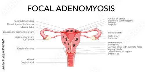 Adenomyosis Focal with inscriptions, Human anatomy Female reproductive Sick system organs. Structure of uterus, cervix, ovary, fallopian tube in Latin text. Frontal view in a cut Vector illustration