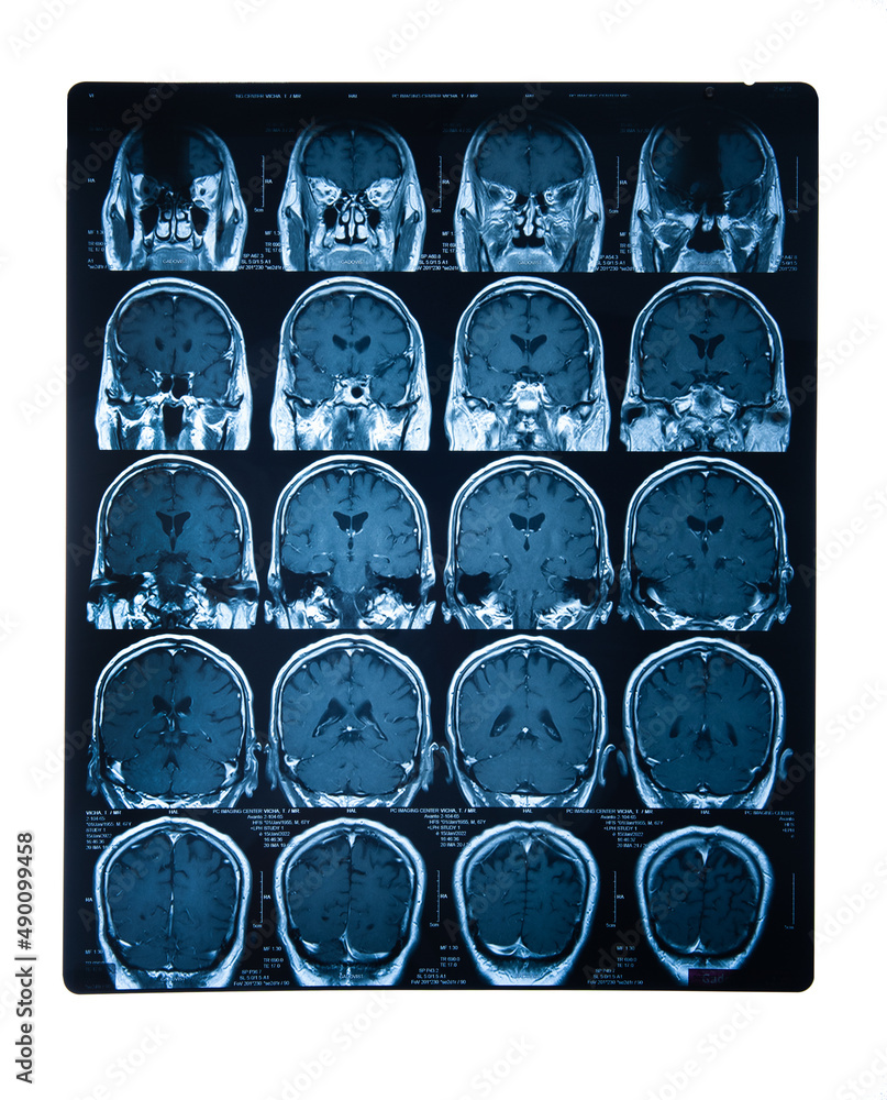 Brain stroke x-ray;MRI of the blood vessels in the brain and ...