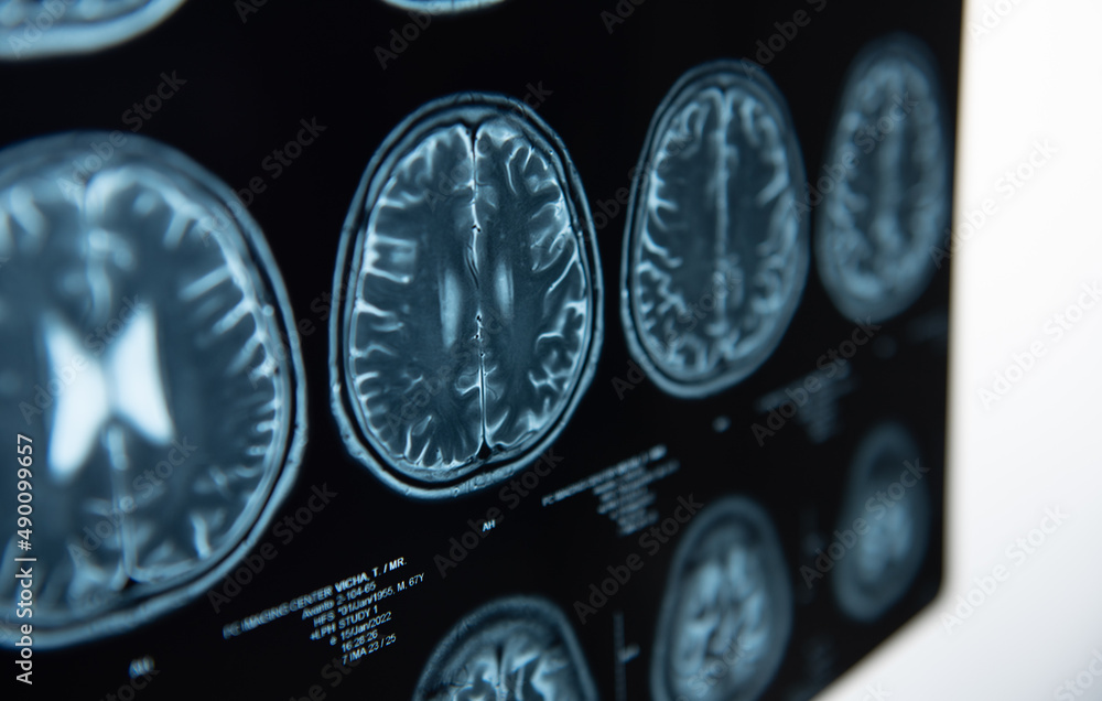 Brain stroke x-ray;MRI of the blood vessels in the brain and ...