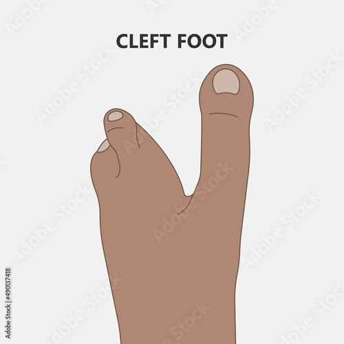 Hand finger gene prader willi band autism surgery baby simple thumb Apert minor born toes feet fused club hand Cleft Birth Ulnar multiple leg clubfoot child claw aplasia wrist forearm deformity extra