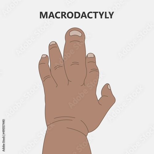 Hand finger gene prader willi band autism surgery baby simple thumb Apert minor born toes feet fused club hand Cleft Birth Ulnar multiple leg clubfoot child claw aplasia wrist forearm deformity extra
