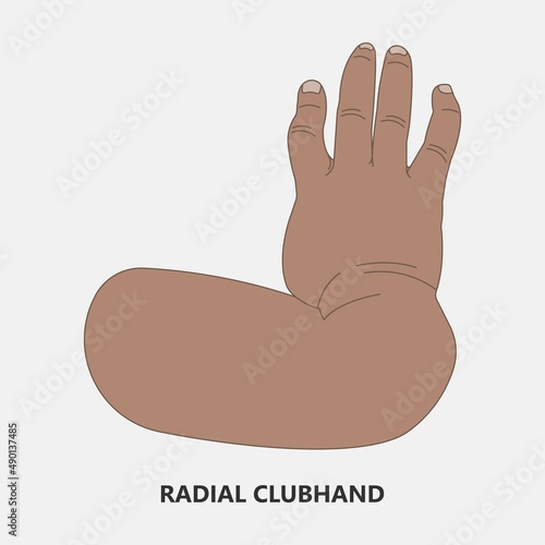 Hand finger gene prader willi band autism surgery baby simple thumb Apert minor born toes feet fused club hand Cleft Birth Ulnar multiple leg clubfoot child claw aplasia wrist forearm deformity extra