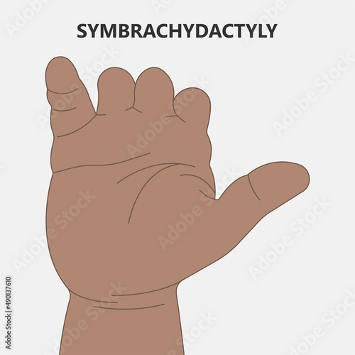 Hand finger gene prader willi band autism surgery baby simple thumb Apert minor born toes feet fused club hand Cleft Birth Ulnar multiple leg clubfoot child claw aplasia wrist forearm deformity extra