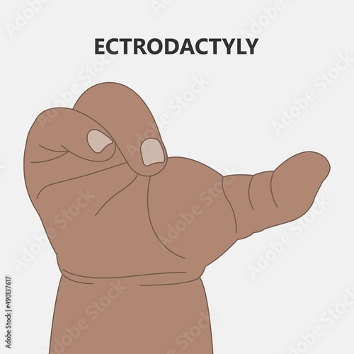 Hand finger gene prader willi band autism surgery baby simple thumb Apert minor born toes feet fused club hand Cleft Birth Ulnar multiple leg clubfoot child claw aplasia wrist forearm deformity extra