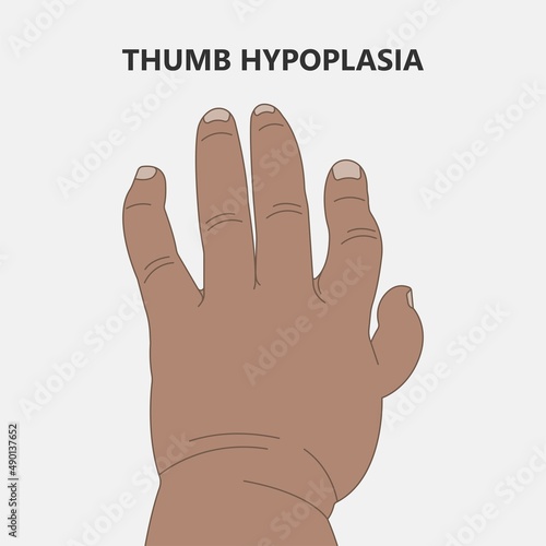 Hand finger gene prader willi band autism surgery baby simple thumb Apert minor born toes feet fused club hand Cleft Birth Ulnar multiple leg clubfoot child claw aplasia wrist forearm deformity extra