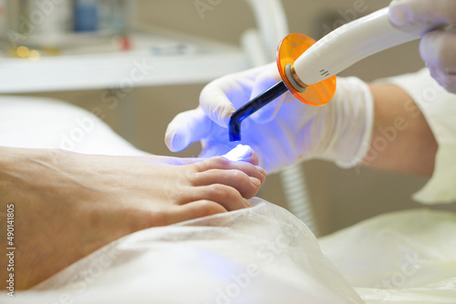 An orthopedist puts a metal nail clamp on an ingrown toenail. It shines with an ultraviolet lamp to harden the glue. Correction of nail deformity. photo