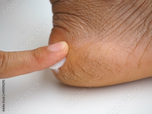 Care for dry skin on the well-groomed feet with creams for the skin and feet. closeup photo, blurred.