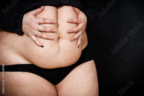 a woman holds her hands on a fat belly on a black background. obese person