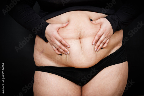 a woman holds with her hands folds of skin on a thick belly on a black background. obese person