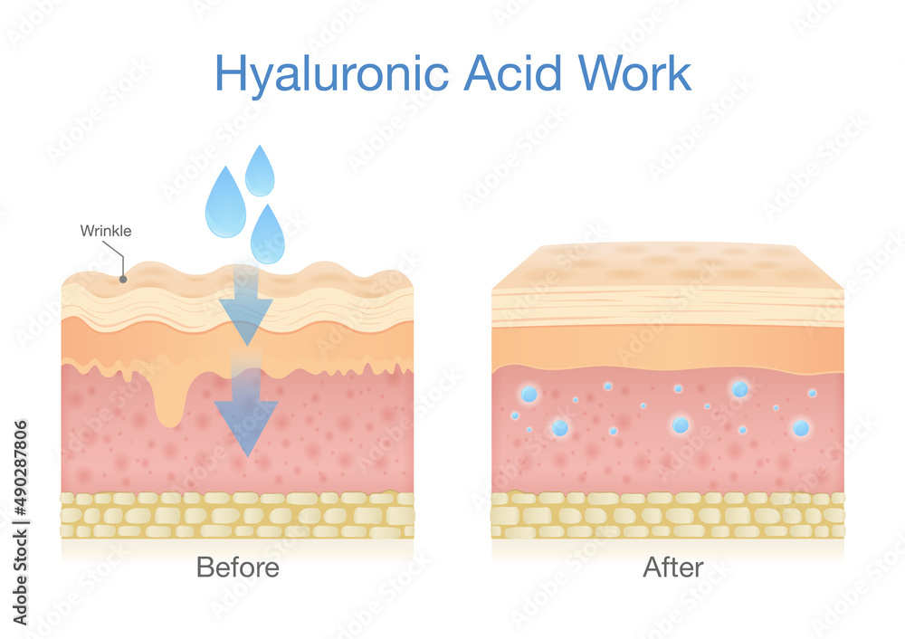 Skin layer getting Hyaluronic Acid increases skin moisture and reduces