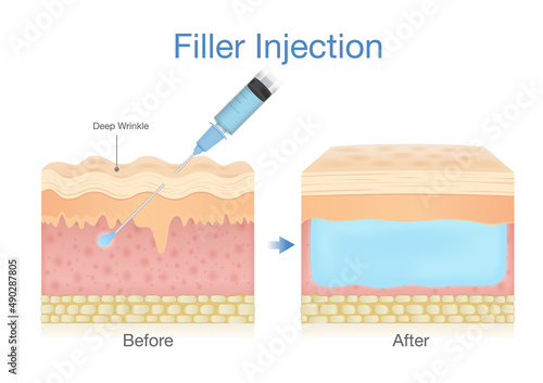 Filler injection into the skin layer by a needle for beauty surgery. Illustration about the result of skin treatment to reduce wrinkle.