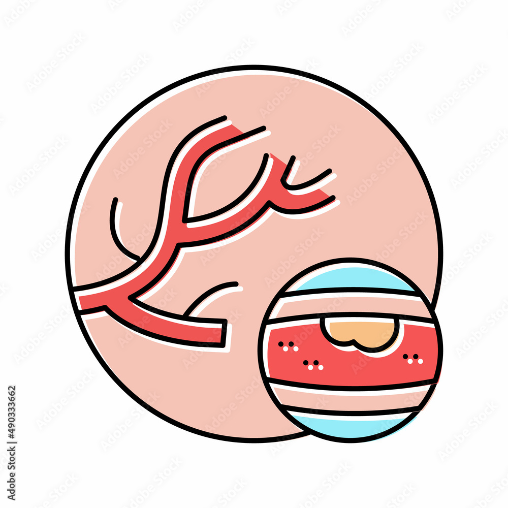 atheroma disease color icon vector illustration