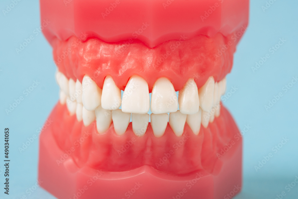 Obraz premium Closeup model with white teeth on blue background. Jaw in dentistry. Clean denture, model of the jaw. Dental, oral surgery, stomatology, orthodontist concept