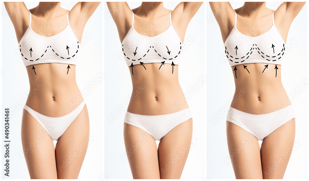 Foto Stock Perfect body of young and beautiful woman in swimsuit. Collage  with arrows. Weight loss, sport and aesthetic medicine. | Adobe Stock