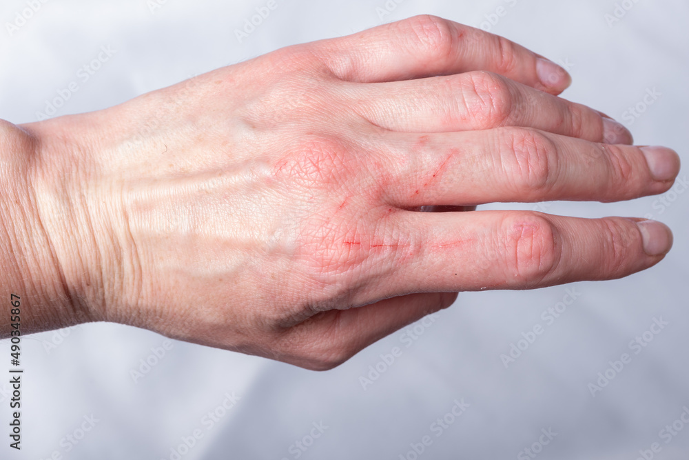 Skin condition after a cat scratch and bite. A hand scratched by a curious little kitten, a cat. Red wounds on the arm, close-up Skin condition after a cat scratch and bite. A hand scratched by a curious little kitten, a cat. Red wounds on the arm, close-up