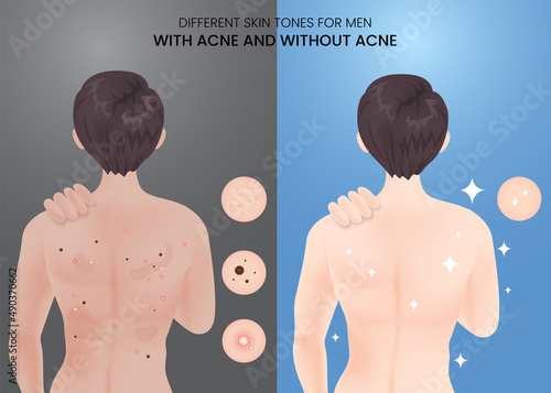 Different skin tones for men with acne and without acne