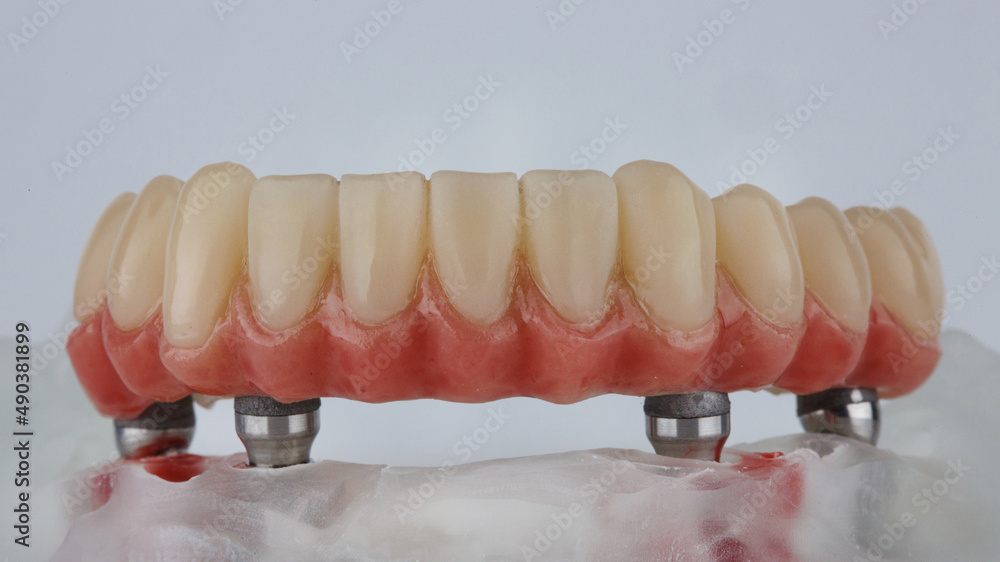 excellent dental prosthesis of the lower jaws on a model with a metal beam on a white background excellent dental prosthesis of the lower jaws on a model with a metal beam on a white background