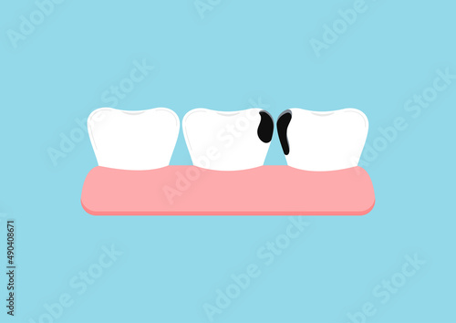 Teeth with proximal decay in gym dental icon isolated on blue background. Both tooth with interdental caries hole treatment concept. Flat cartoon dentistry clip art vector illustration