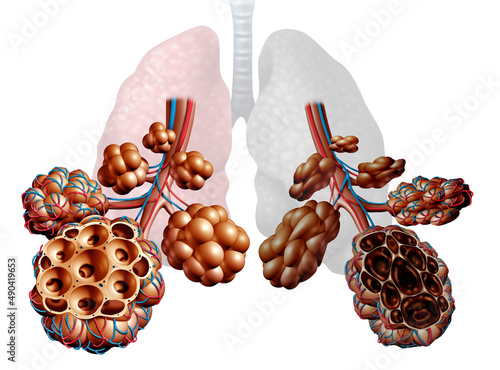 Emphysema as shortness of breath, lung disorder as a COPD illness and Chronic obstructive pulmonary disease medical concept as bronchioles and alveoli are damaged. photo