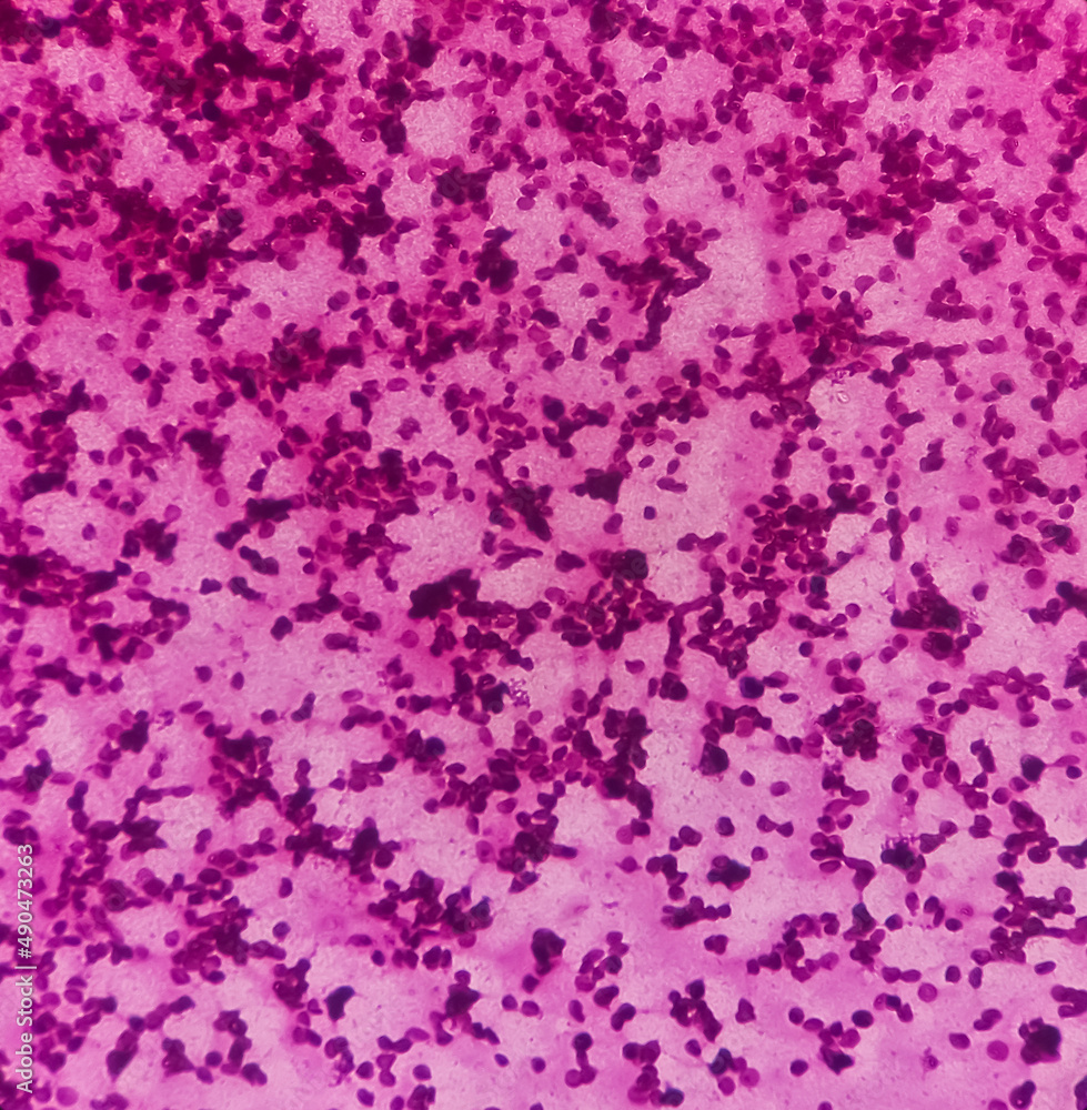 Microscopic image of vertebral lesion cytology, Inflammatory lesion, show polymorphs, lymphocytes, histiocytes,fibrous tissue, blood cell background.