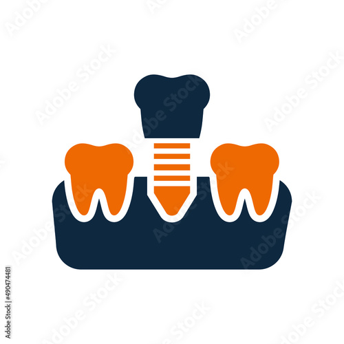 Dental screw, tooth implanting icon. Simple editable vector graphics.