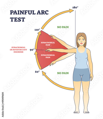 Painful arc test and physiopedia syndrome medical diagnosis outline diagram. Labeled educational position scheme with subacromial pain angle in hand movement vector illustration. Rotator cuff disorder photo