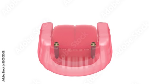Bar retained removable overdenture installation supported by implants