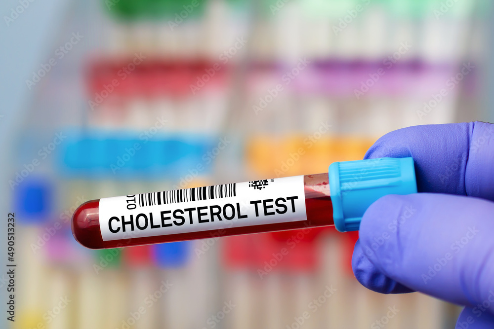 Blood sample of patient for analysis of Cholesterol test in laboratory