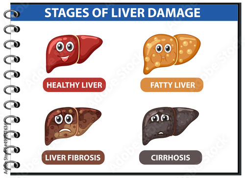 Diagram showing stages of liver damage