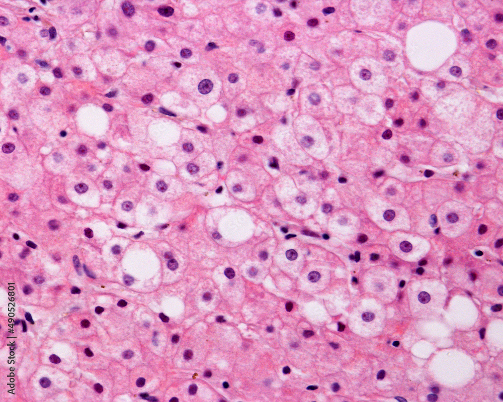 Human liver. Steatosis Human liver. Steatosis