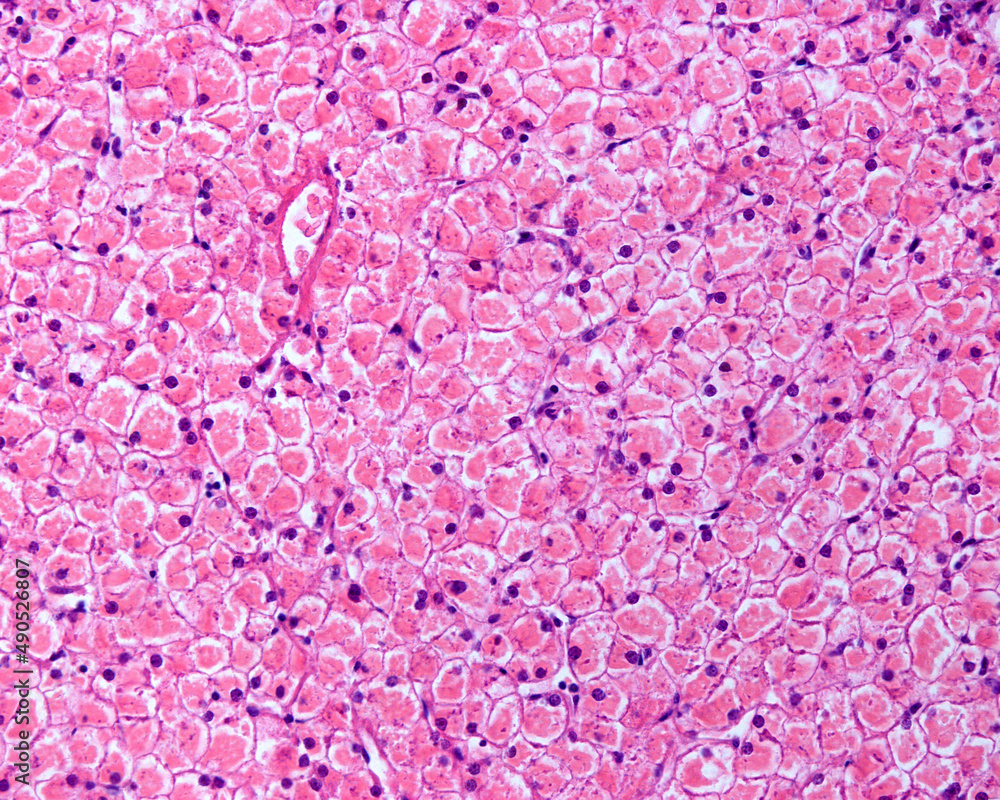 Obraz premium Human liver. Glycogenosis