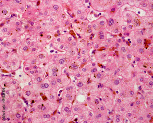 Human liver. Cholestasis. Bile pigment photo