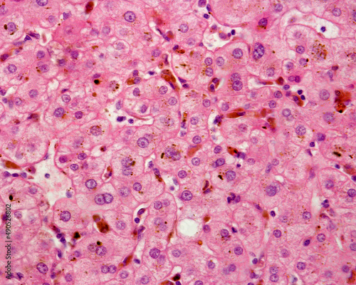 Canvastavla Human liver. Cholestasis. Bile pigment