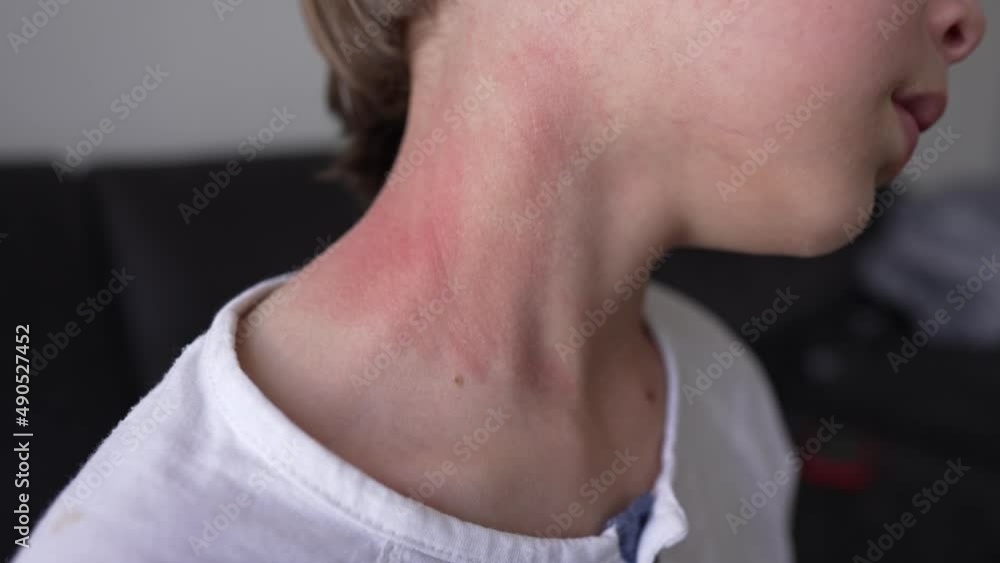 Photophobia Rash Allergic skin reaction on the childs neck and face - red rash. Symptoms ...