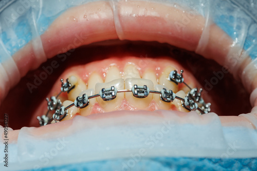 Close-up of teeth with braces, dental checkup in the dental office. The dentist examines the patient's teeth with dental instruments. Dentistry. selective focus