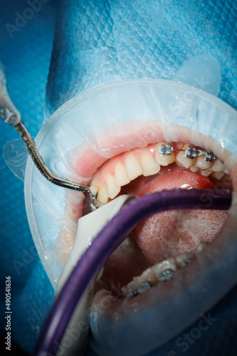 Top view of the process of brushing the patient's teeth. Teeth cleaning with water jet and saliva ejector. Cheek retractor on lips. The concept of professional oral hygiene. Braces on teeth