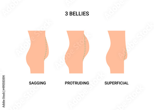 Types bellies of human body, big belly with overweight. Sagging, protruding and superficial tummy. Loss weight, reduce volume belly, surgery plastic operation. Vector illustration