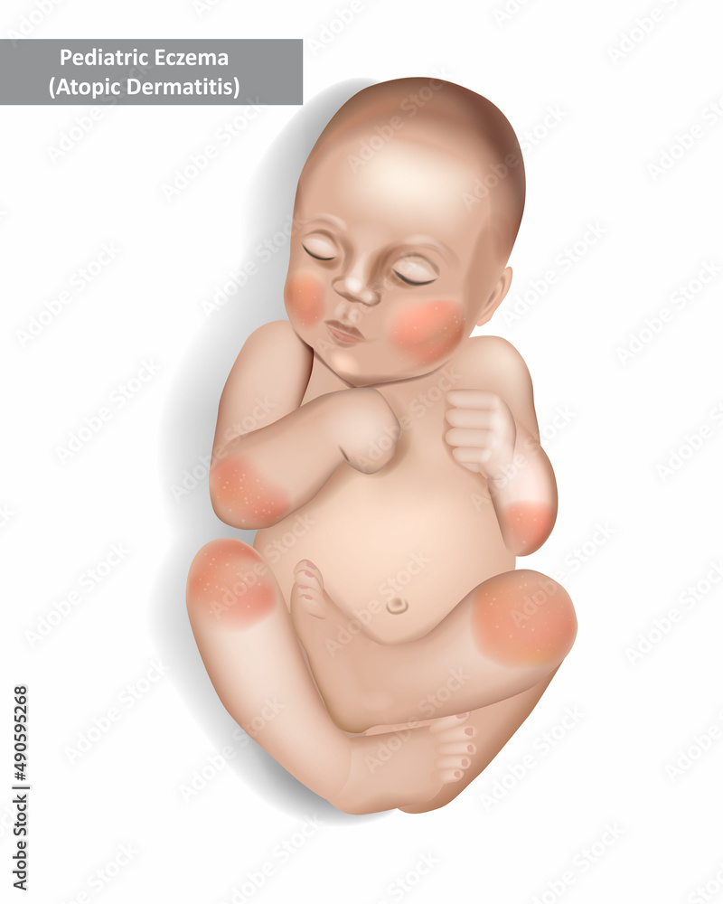 Pediatric Eczema or Atopic Dermatitis in infants and children. Vector illustration Pediatric Eczema or Atopic Dermatitis in infants and children. Vector illustration