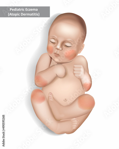 Pediatric Eczema or Atopic Dermatitis in infants and children. Vector illustration