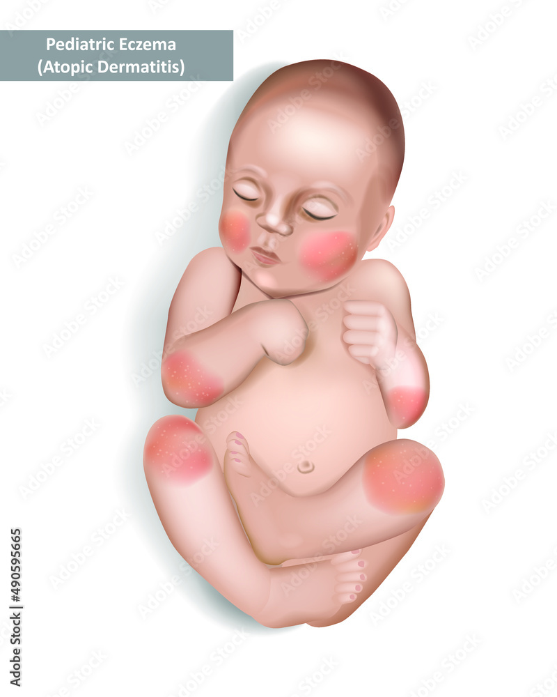 Pediatric Eczema or Atopic Dermatitis in infants and children. Vector illustration Pediatric Eczema or Atopic Dermatitis in infants and children. Vector illustration