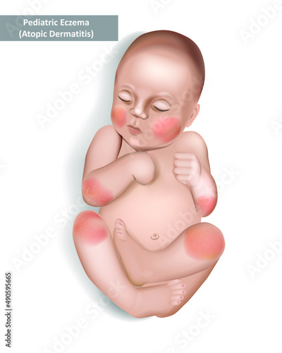 Pediatric Eczema or Atopic Dermatitis in infants and children. Vector illustration