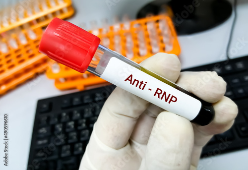 Blood sample for Anti-RNP(antinuclear ribonucleoprotein)antibodies test, diagnosis of mixed connective tissue disease. photo