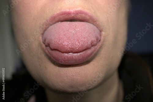 Fotografie, Obraz swollen enlarged white tongue with wavy ripple scalloped edges (medical name is