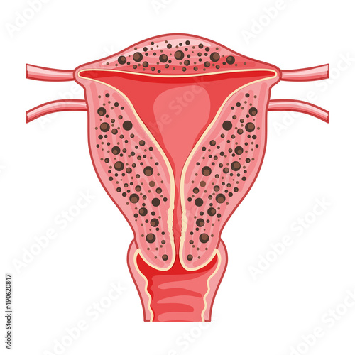 Diffuse Adenomyosis Human anatomy Female reproductive Sick system organs location scheme, uterus vagina icon vector medical Cross section Realistic flat illustration isolated on white background