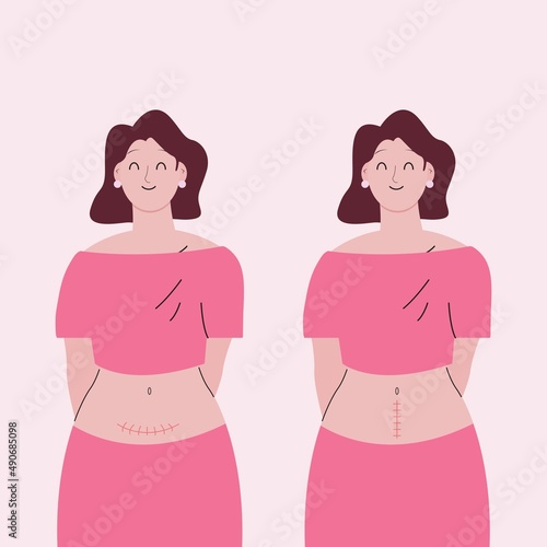 Woman with horizontal and vertical cesarean wound